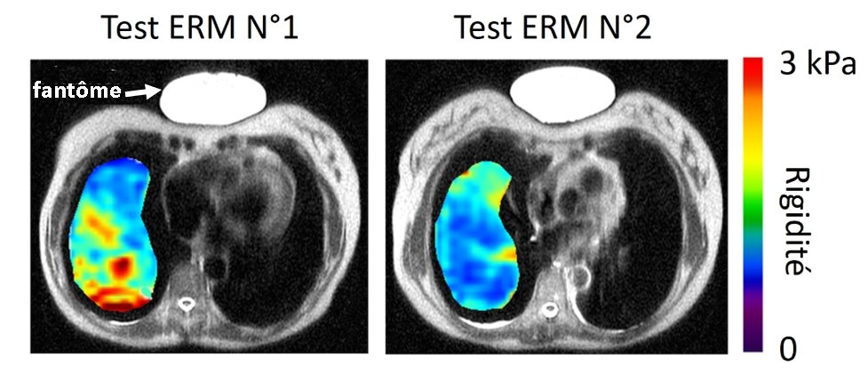 Suivi de l’évolution de la rigidité pulmonaire pour un patient atteint d’un COVID long."